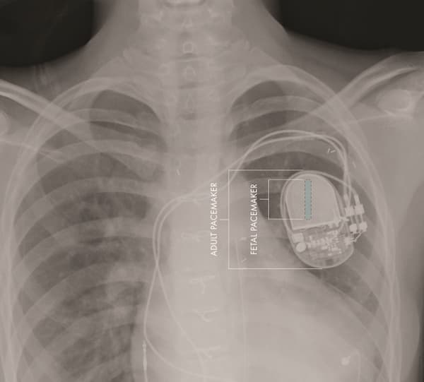 fully-implantable-pacemaker-launch