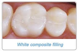 tooth-coloured-composite-filling