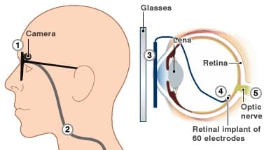 artificial-retina-bionic-eye